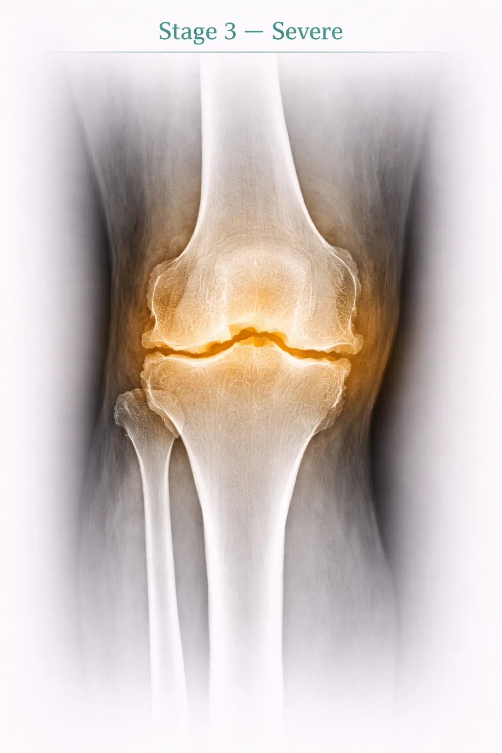 Stage 3 - Severe osteoarthritis in knee joint X-ray
