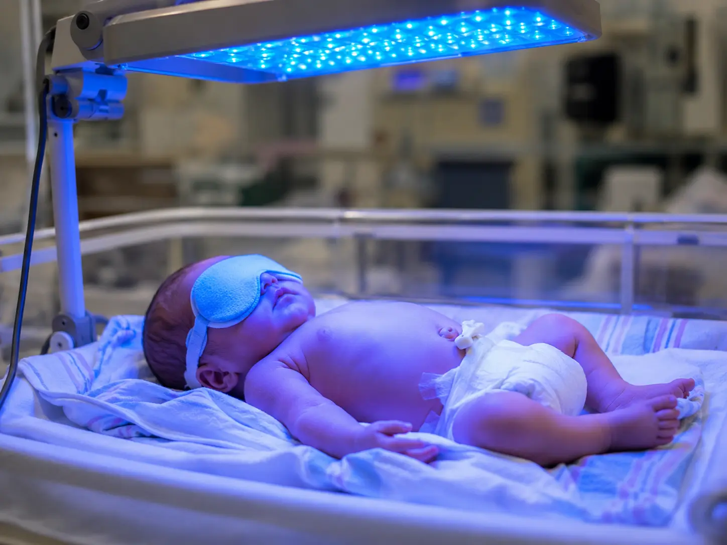 Newborn baby receiving phototherapy treatment for jaundice